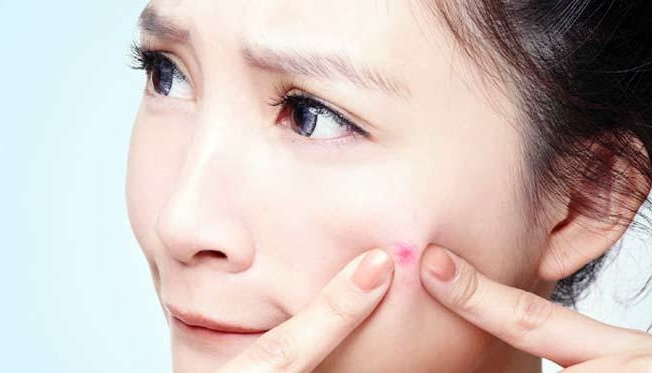 menghilangkan-jerawat