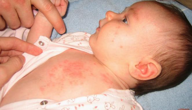 Biang keringat pada bayi